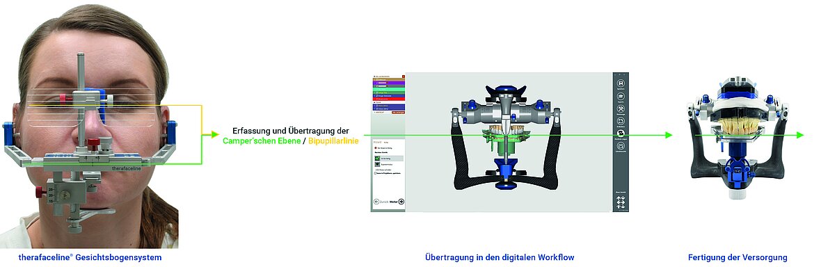 therafaceline® Gesichtsbogen, Übertragung der Camperschen Ebene in den digitalen Workflow